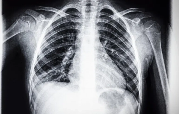 Штучний інтелект може допомагати медикам читати рентген грудної клітини